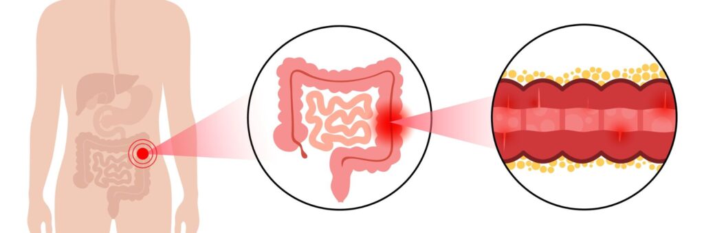 Nόσος Crohn